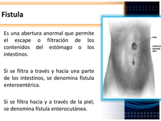 Fistula
Es una abertura anormal que permite
el escape o filtración de los
contenidos del estómago o los
intestinos.
Si se filtra a través y hacia una parte
de los intestinos, se denomina fístula
enteroentérica.
Si se filtra hacia y a través de la piel,
se denomina fístula enterocutánea.
 