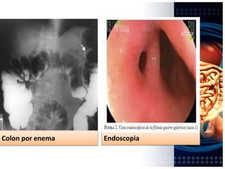 Colon por enema Endoscopia
 