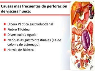 Causas mas frecuentes de perforación
de víscera hueca:
Ulcera Péptica gastroduodenal
Fiebre Tifoidea
Diverticulitis Aguda
Neoplasias gastrointestinales (Ca de
colon y de estomago).
Hernia de Richter.
 
