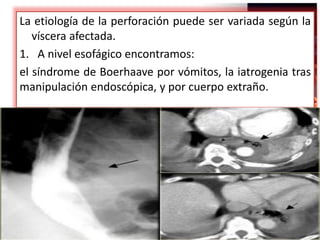 La etiología de la perforación puede ser variada según la
víscera afectada.
1. A nivel esofágico encontramos:
el síndrome de Boerhaave por vómitos, la iatrogenia tras
manipulación endoscópica, y por cuerpo extraño.
 