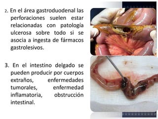 2. En el área gastroduodenal las
perforaciones suelen estar
relacionadas con patología
ulcerosa sobre todo si se
asocia a ingesta de fármacos
gastrolesivos.
3. En el intestino delgado se
pueden producir por cuerpos
extraños, enfermedades
tumorales, enfermedad
inflamatoria, obstrucción
intestinal.
 