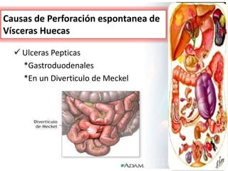 Causas de Perforación espontanea de
Vísceras Huecas
 Ulceras Pepticas
*Gastroduodenales
*En un Diverticulo de Meckel
 