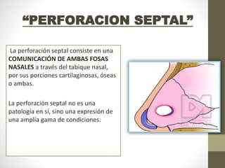 La perforación septal consiste en una
COMUNICACIÓN DE AMBAS FOSAS
NASALES a través del tabique nasal,
por sus porciones cartilaginosas, óseas
o ambas.
La perforación septal no es una
patología en sí, sino una expresión de
una amplia gama de condiciones.
“PERFORACION SEPTAL”
 