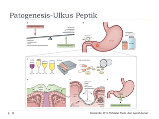 Patogenesis-Ulkus Peptik
8 Soreide dkk. 2015. Perforated Peptic Ulcer. Lancet Journal.
 