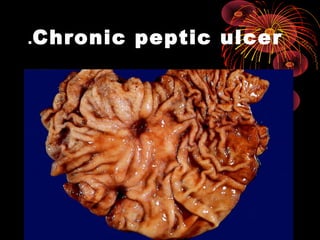 Chronic peptic ulcer.
 