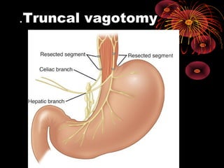 Truncal vagotomy.
 
