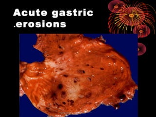 Acute gastric
erosions.
 