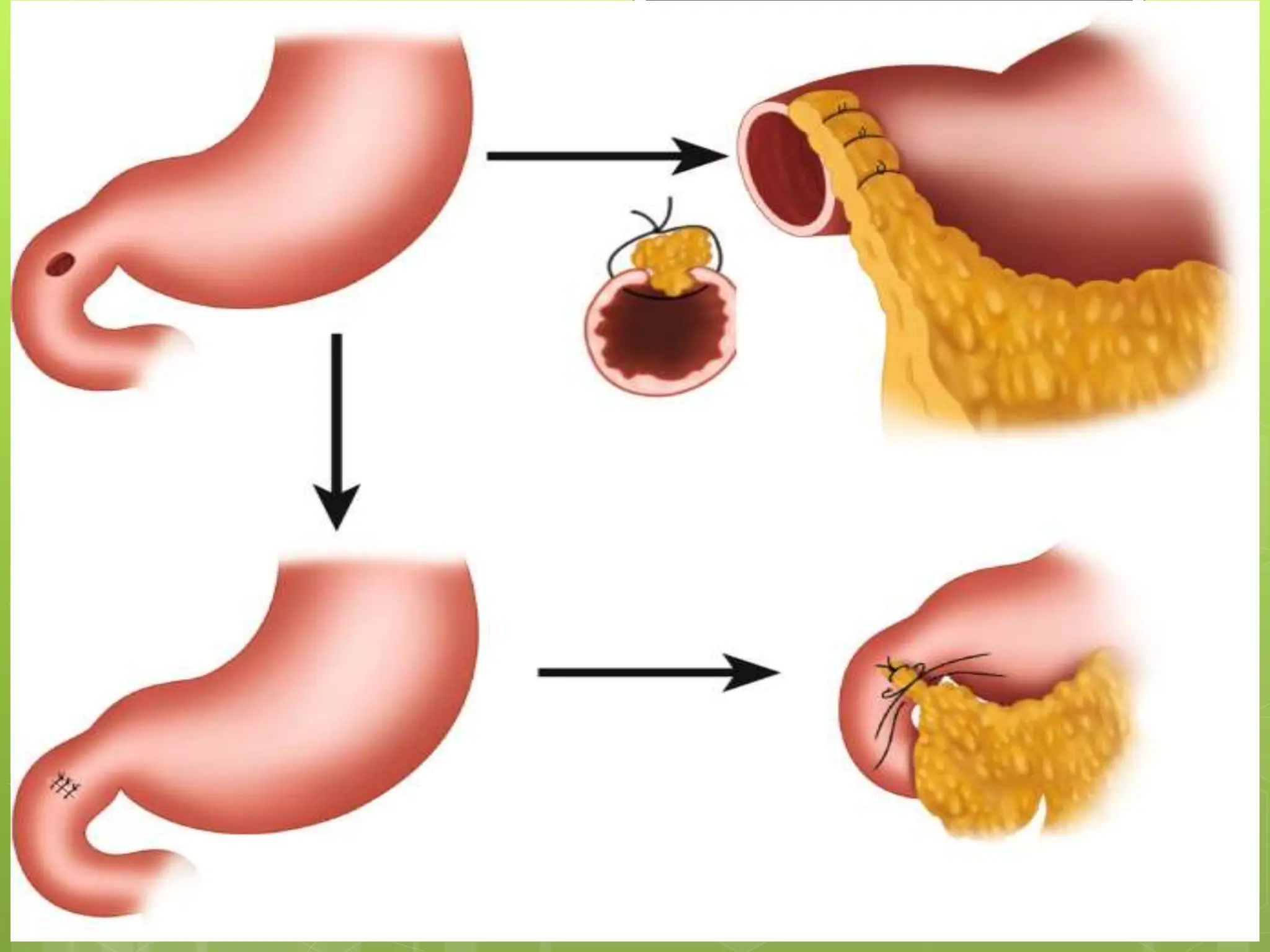 Perforation Injuries Perforation.pptx