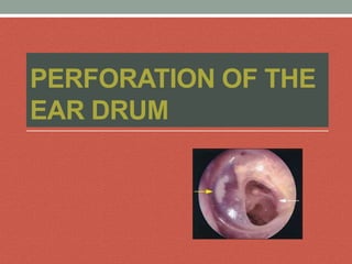 PERFORATION OF THE
EAR DRUM
 
