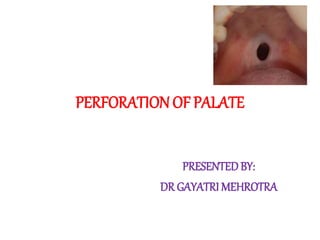 PERFORATIONOF PALATE
PRESENTEDBY:
DR GAYATRI MEHROTRA
 