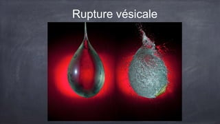 Rupture vésicale 
 