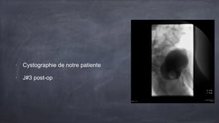 • Cystographie de notre patiente 
• J#3 post-op 
