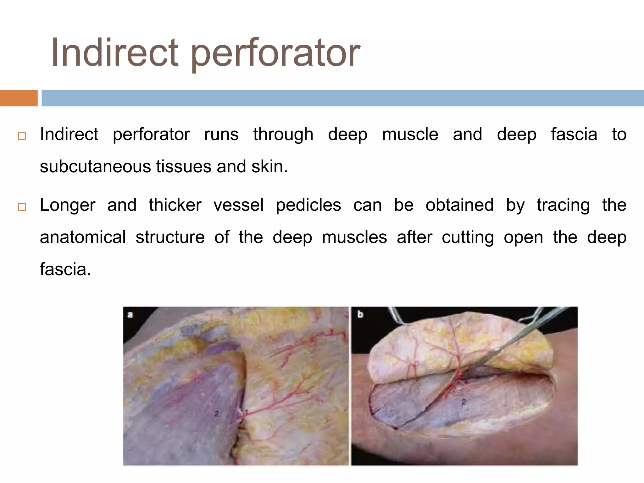 Indirect perforator
 Indirect perforator runs through deep muscle and deep fascia to
subcutaneous tissues and skin.
 Longer and thicker vessel pedicles can be obtained by tracing the
anatomical structure of the deep muscles after cutting open the deep
fascia.
 