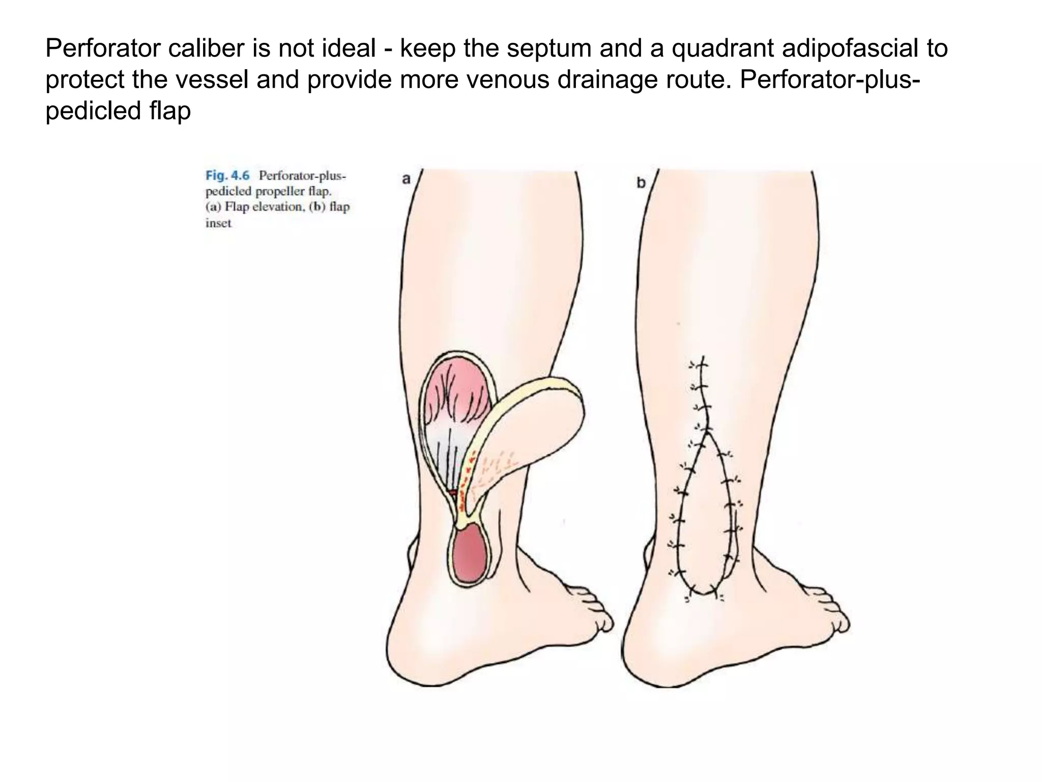Perforator caliber is not ideal - keep the septum and a quadrant adipofascial to
protect the vessel and provide more venous drainage route. Perforator-plus-
pedicled flap
 