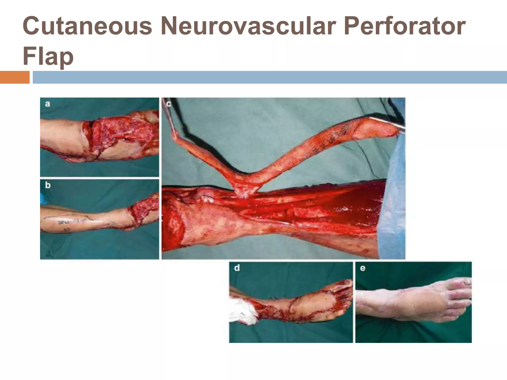 Cutaneous Neurovascular Perforator
Flap
 