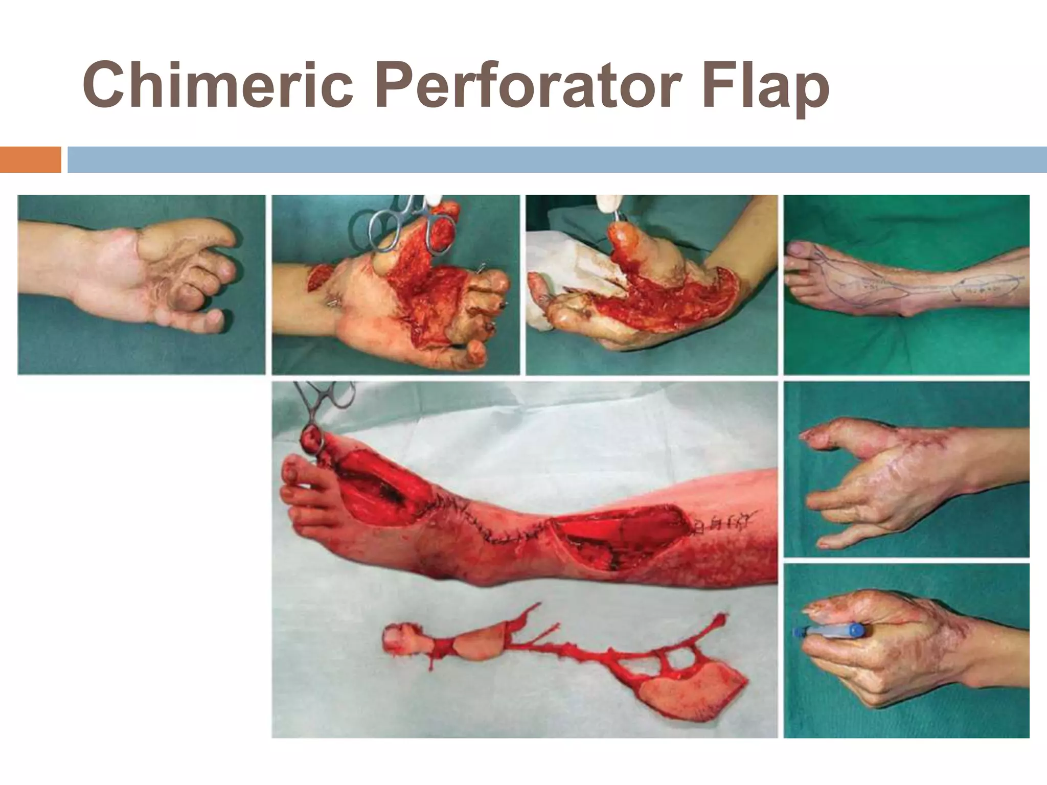 Chimeric Perforator Flap
 