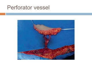 Perforator vessel
 