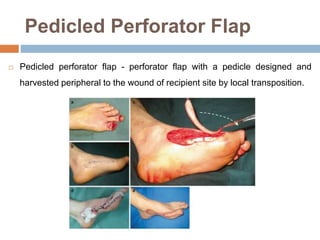 Pedicled Perforator Flap
 Pedicled perforator flap - perforator flap with a pedicle designed and
harvested peripheral to the wound of recipient site by local transposition.
 