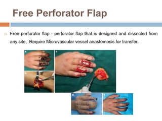 Free Perforator Flap
 Free perforator flap - perforator flap that is designed and dissected from
any site, Require Microvascular vessel anastomosis for transfer.
 