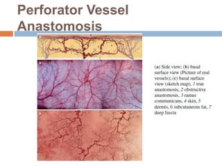 Perforator Vessel
Anastomosis
 