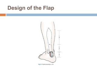Design of the Flap
 