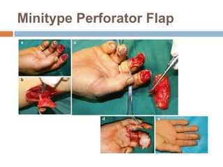 Minitype Perforator Flap
 