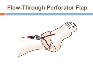 Flow-Through Perforator Flap
 