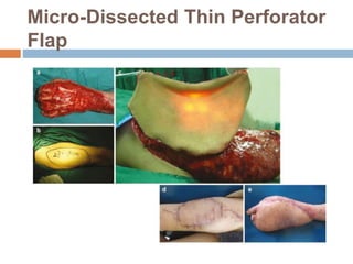 Micro-Dissected Thin Perforator
Flap
 