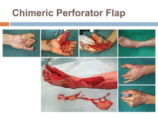 Chimeric Perforator Flap
 