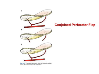 Conjoined Perforator Flap
 