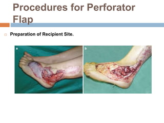 Procedures for Perforator
Flap
 Preparation of Recipient Site.
 
