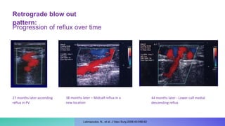 Retrograde blow out
pattern:
27 months later ascending
reflux in PV
44 months later - Lower calf medial
descending reflux
38 months later – Midcalf reflux in a
new location
Progression of reflux over time
Labropoulos, N., et al. J Vasc Surg 2006:43:558-62
 