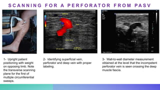 2- Identifying superficial vein,
perforator and deep vein with proper
labeling.
1- Upright patient
positioning with weight
on opposing limb. Note
the transverse scanning
plane for the first of
multiple circumferential
sweeps.
3- Wall-to-wall diameter measurement
obtained at the level that the incompetent
perforator vein is seen crossing the deep
muscle fascia.
S C A N N I N G F O R A P E R F O R A T O R F R O M P A S V
 