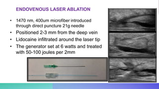 • 1470 nm, 400um microfiber introduced
through direct puncture 21g needle
• Positioned 2-3 mm from the deep vein
• Lidocaine infiltrated around the laser tip
• The generator set at 6 watts and treated
with 50-100 joules per 2mm
ENDOVENOUS LASER ABLATION
 