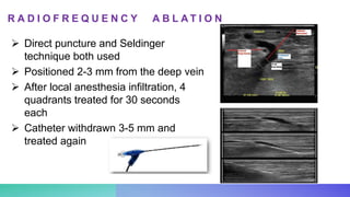  Direct puncture and Seldinger
technique both used
 Positioned 2-3 mm from the deep vein
 After local anesthesia infiltration, 4
quadrants treated for 30 seconds
each
 Catheter withdrawn 3-5 mm and
treated again
R A D I O F R E Q U E N C Y A B L A T I O N
 
