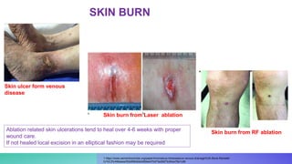 1 https://www.semanticscholar.org/paper/Anomalous-intraosseous-venous-drainage%3A-Bone-Ramelet-
Cr%C3%A9bassa/52e90fb0de2d69de470d73a28d73c0bce75e1c9b
Skin burn from RF ablation
Skin ulcer form venous
disease
Skin burn from Laser ablation
Ablation related skin ulcerations tend to heal over 4-6 weeks with proper
wound care.
If not healed local excision in an elliptical fashion may be required
SKIN BURN
 