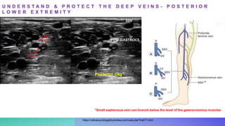 U N D E R S T A N D & P R O T E C T T H E D E E P V E I N S - P O S T E R I O R
L O W E R E X T R E M I T Y
Posterior Leg
*Small saphenous vein can branch below the level of the gastrocnemius muscles
*
Artery
Veins
https://ultrasoundregistryreview.com/vascularTrial17.html
 