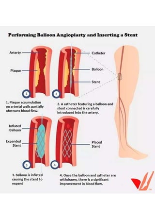 Performing Balloon Angioplasty and Inserting a Stent - USA Vascular Centers 