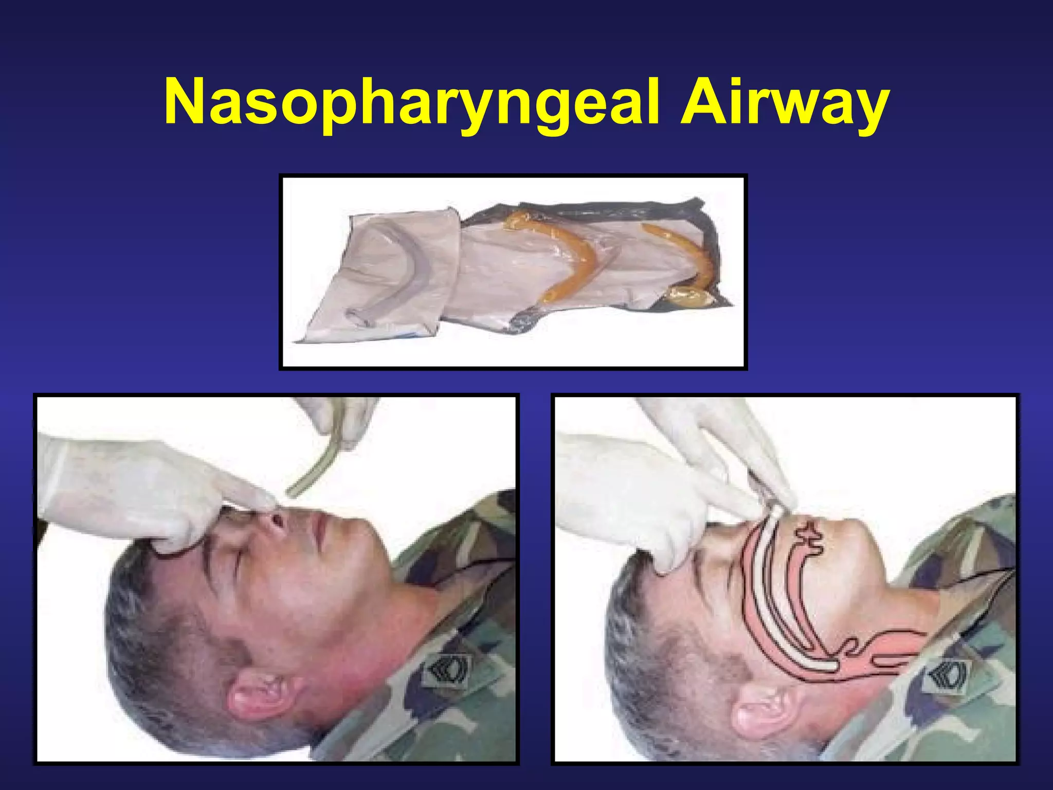 Care Under Fire Hemorrhage   from extremities is the 1 st  leading cause of preventable combat deaths Prompt use of tourniquets to   stop the bleeding   may be life-saving in this phase 