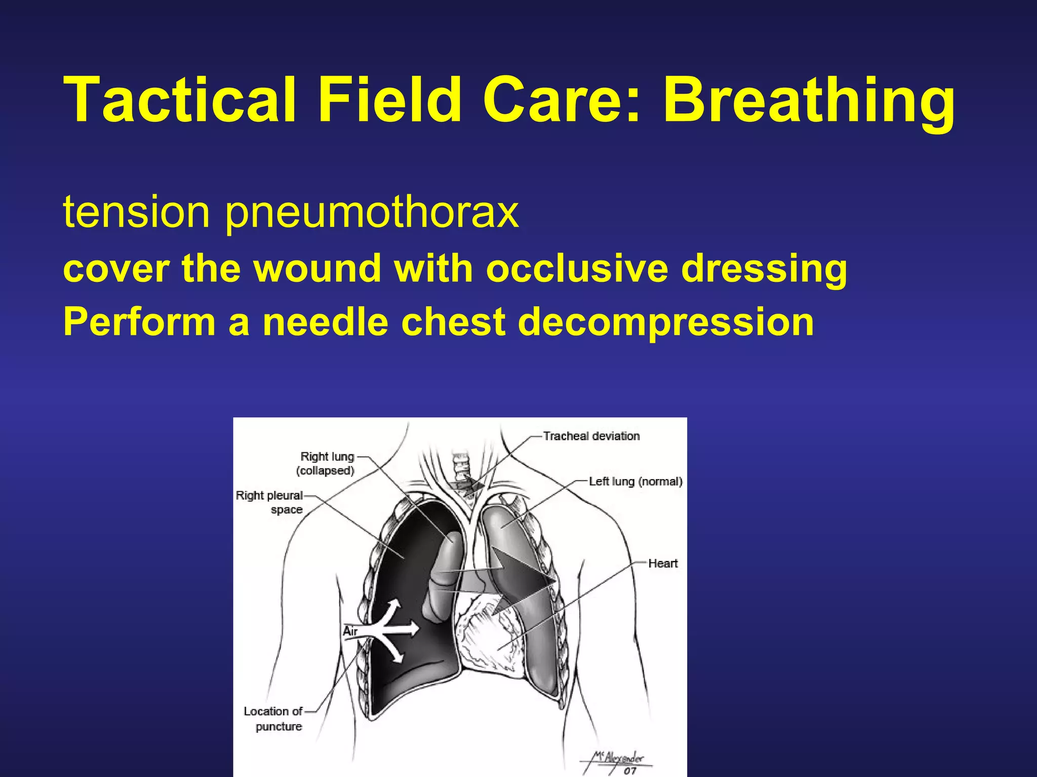 Combat Application Tourniquet (CAT) WINDLASS OMNI TAPE BAND WINDLASS STRAP 