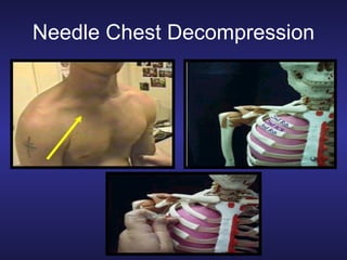 Perform tactical combat casualty care | PPT