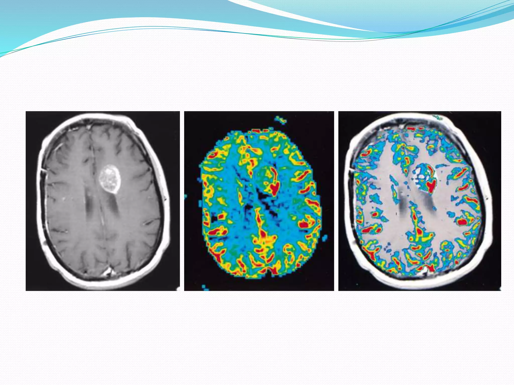 Perfusion and dynamic contrast enhanced mri | PPTX