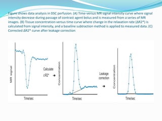 Figure shows data analysis in DSC perfusion. (A) Time-versus MR signal intensity curve where signal
intensity decrease during passage of contrast agent bolus and is measured from a series of MR
images. (B) Tissue concentration-versus time curve where change in the relaxation rate (ΔR2*) is
calculated from signal intensity, and a baseline subtraction method is applied to measured data. (C)
Corrected ΔR2* curve after leakage correction
 