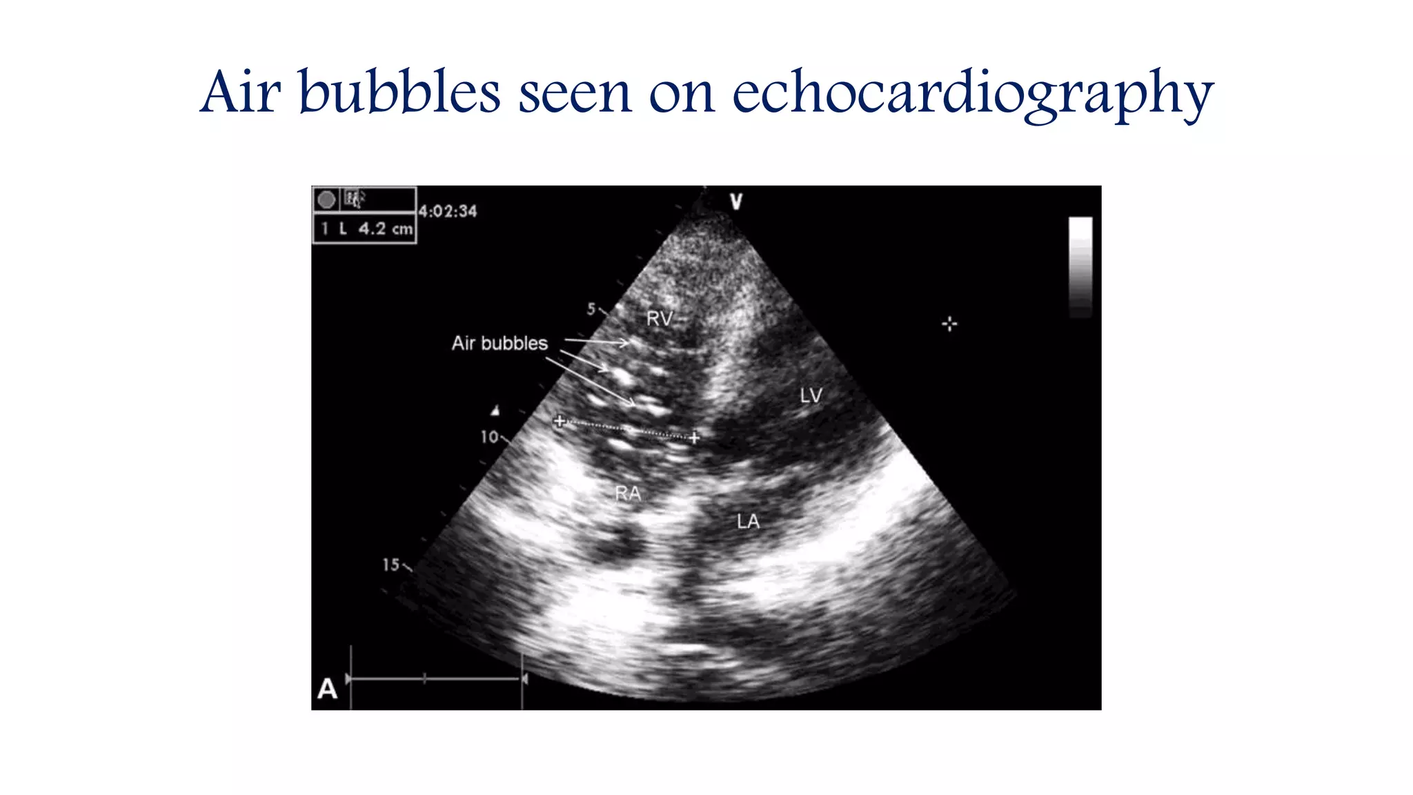Air bubbles seen on echocardiography
 