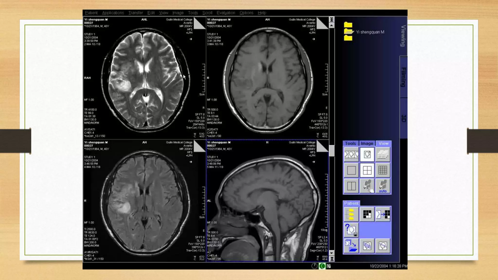 Perfusion MRI (DSC and DCE perfusion techniques) for radiology ...