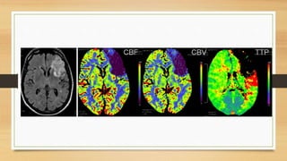 Perfusion MRI (DSC and DCE perfusion techniques) for radiology ...