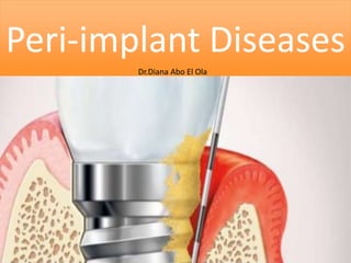 Peri-implant Diseases
Dr.Diana Abo El Ola
 