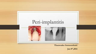 Peri-implantitis
Thanwadee Immsombatti
Jan 8th,2014
 