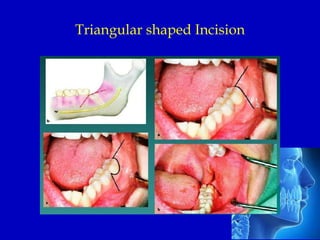 Impacted third molar management | PPTX