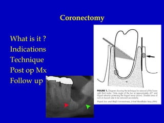 Impacted third molar management | PPTX